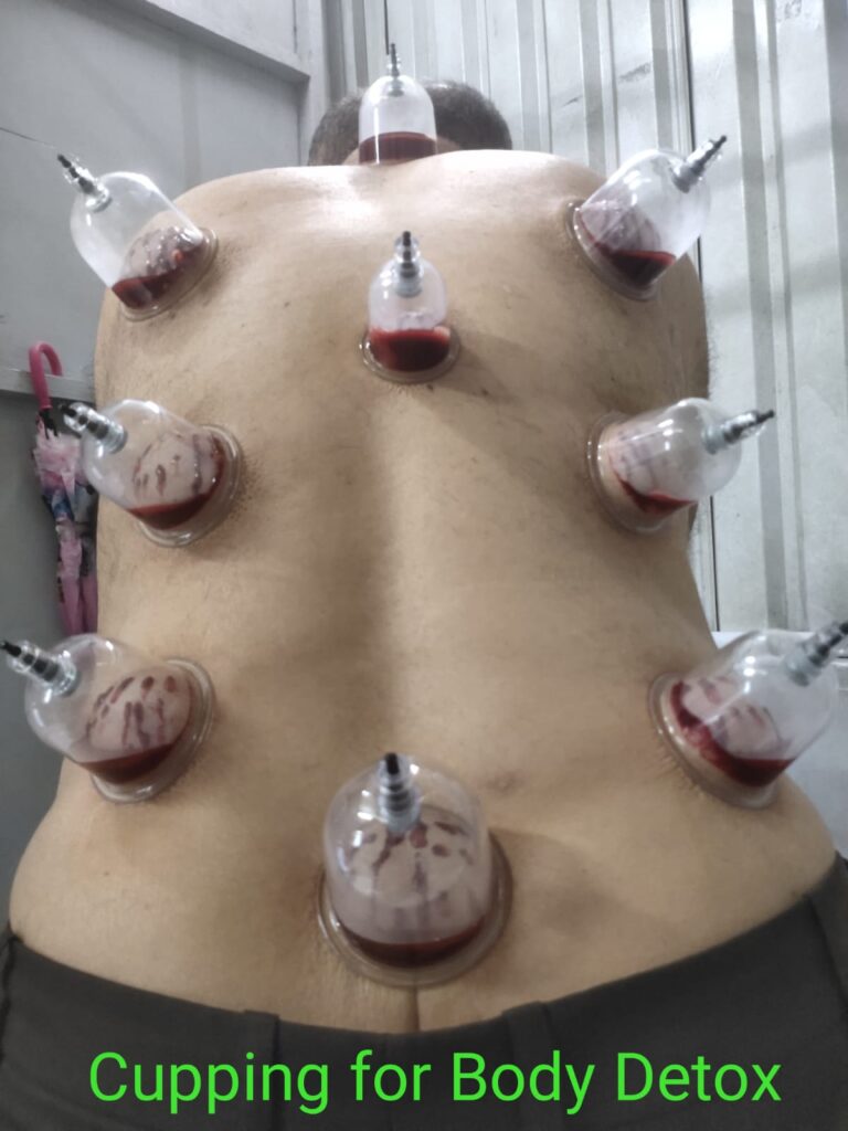 Body-Detox-cupping Cupping Hijama herapy Benefits