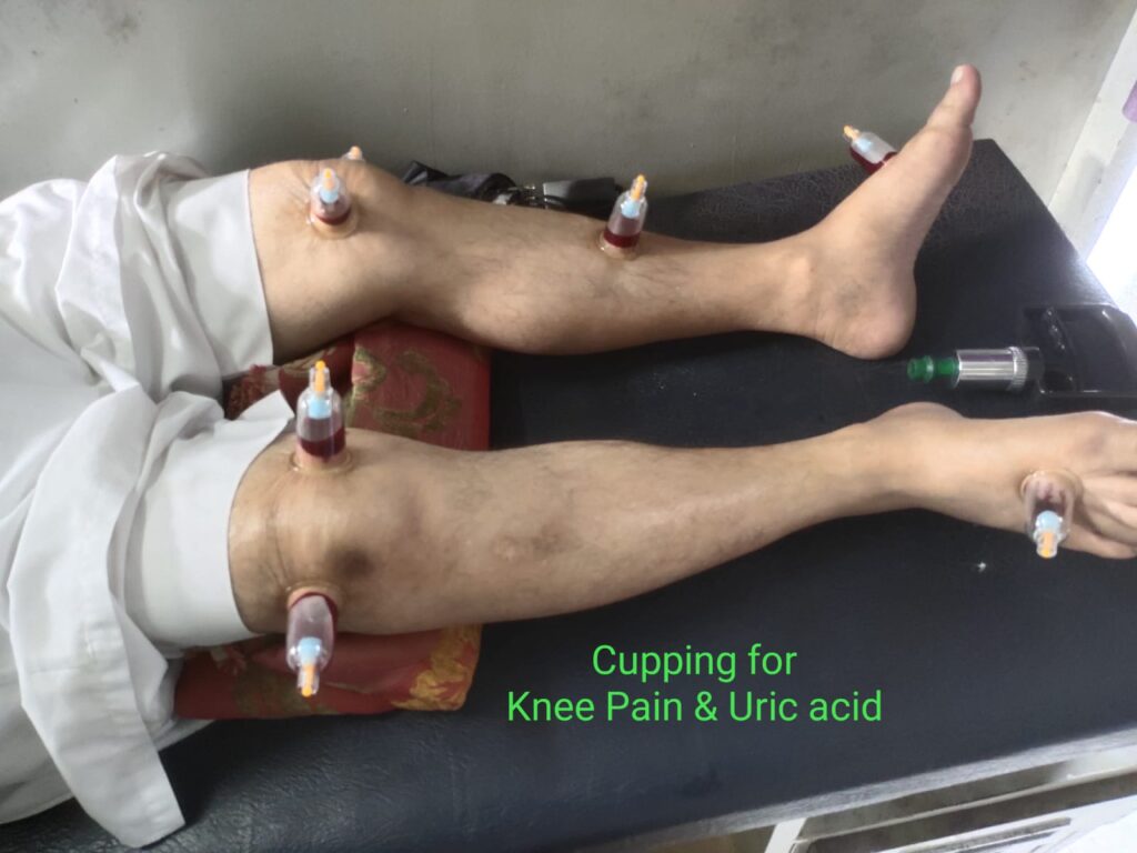 Cupping Hijama Therapy Benefits 2